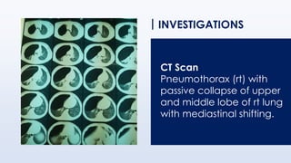 INVESTIGATIONS
CT Scan
Pneumothorax (rt) with
passive collapse of upper
and middle lobe of rt lung
with mediastinal shifting.
 