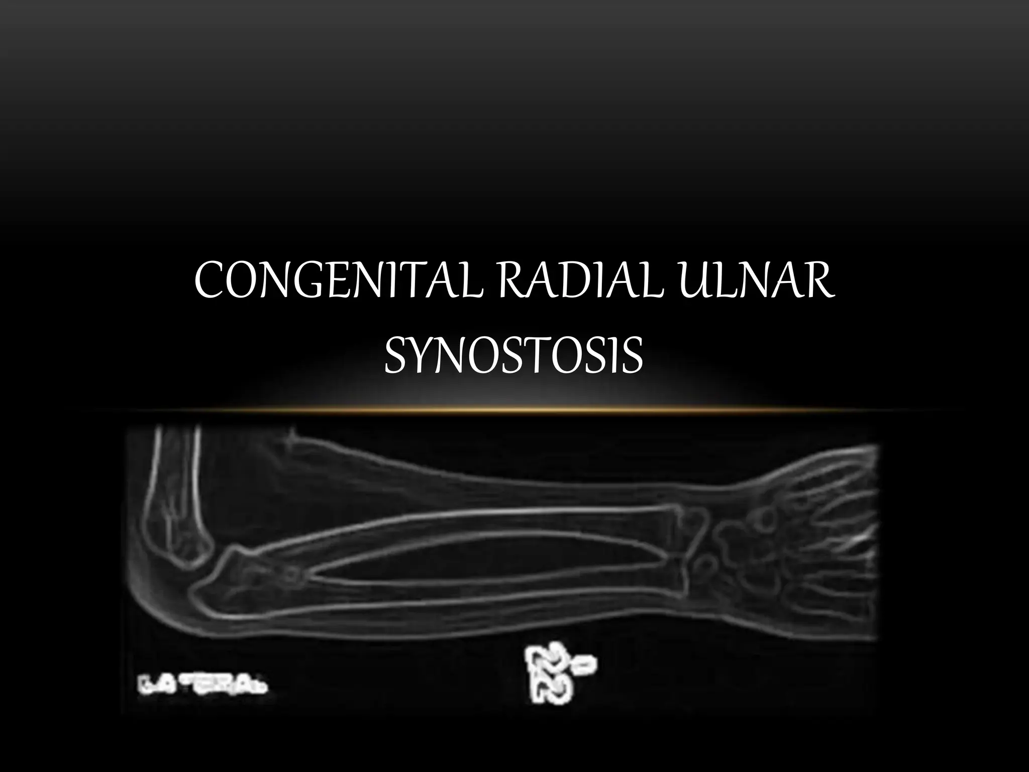 Congenital Radial Ulnar Synostosis.pptx