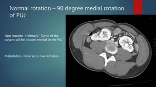 Renal Rotation Radiology Congenital renal anomalies | PPTX