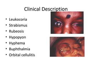 Negative Rubeosis Congenital retinal anomalies | PPT