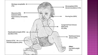 Congenital rubella syndrome