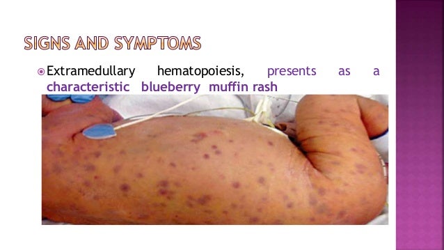 congenital-rubella-syndrome-blueberry-muffin-rash-congenital-rubella
