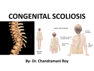 CONGENITAL SCOLIOSIS
By- Dr. Chandramani Roy
 