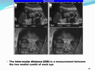 Interocular Distance Radiology imaging in intrauterine skeletal dysplasia | PPTX