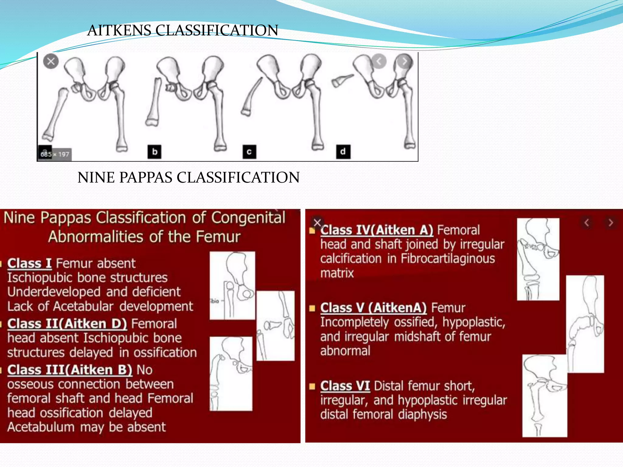 Congenital skeletal limb deficiences | PPTX
