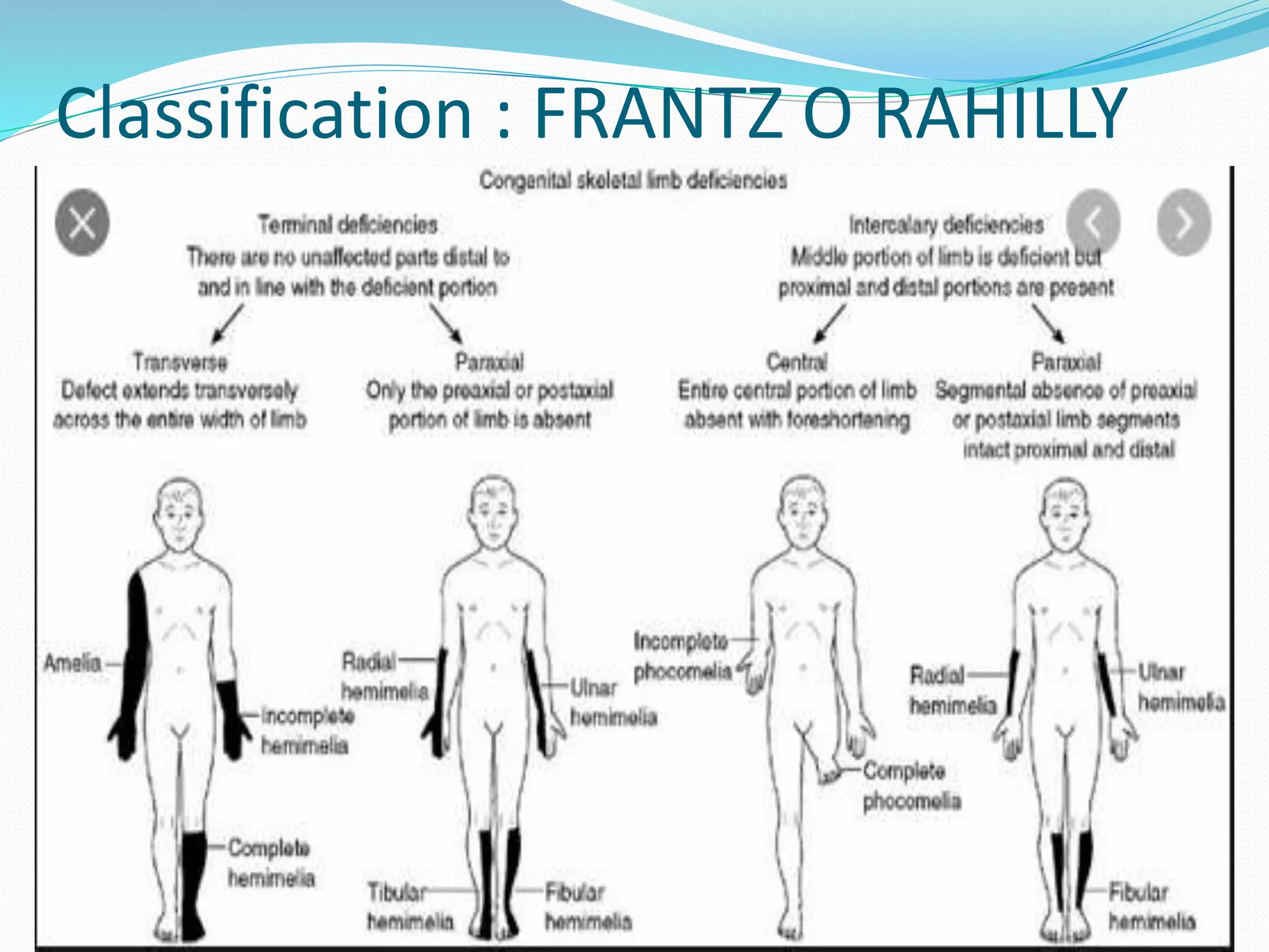 Congenital skeletal limb deficiences | PPTX