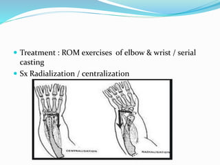  Treatment : ROM exercises of elbow & wrist / serial
casting
 Sx Radialization / centralization
 