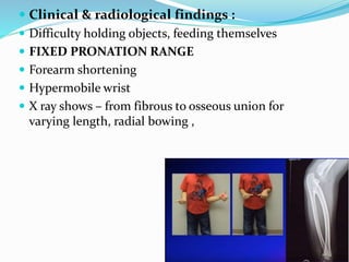  Clinical & radiological findings :
 Difficulty holding objects, feeding themselves
 FIXED PRONATION RANGE
 Forearm shortening
 Hypermobile wrist
 X ray shows – from fibrous to osseous union for
varying length, radial bowing ,
 