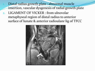 1. Distal radius growth plate : abnormal muscle
insertion, vascular dysgenesis of radial growth plate
2. LIGAMENT OF VICKER : from ulnovolar
metaphyseal region of distal radius to anterior
surface of lunate & anterior radioulanr lig of TFCC
 