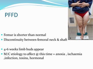 PFFD
 Femur is shorter than normal
 Discontinuity between femoral neck & shaft
 4-6 weeks limb buds appear
 M/C etiology to affect @ this time = anoxia , ischaemia
,infection, toxins, hormonal
 