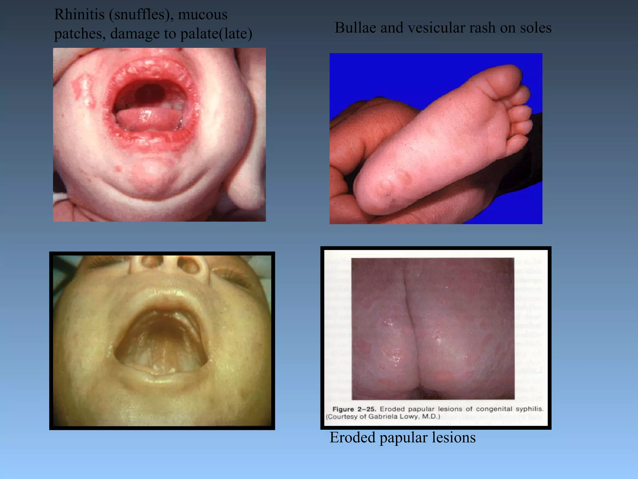 Rhinitis (snuffles), mucous patches, damage to palate(late) Bullae and vesicular rash on soles Eroded papular lesions 
