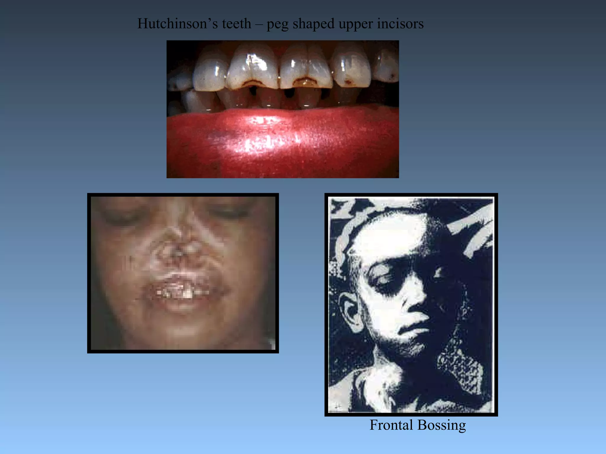 Hutchinson’s teeth – peg shaped upper incisors Frontal Bossing 