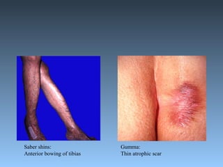 Saber shins: Anterior bowing of tibias Gumma: Thin atrophic scar 