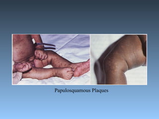 Papulosquamous Plaques 