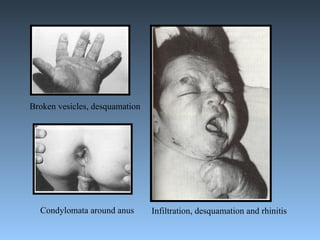 Broken vesicles, desquamation Condylomata around anus Infiltration, desquamation and rhinitis 