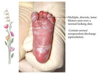 Multiple, discrete, tense
blisters seen over a
normal looking skin
Contain serous/
seropurulent discharge
(spirochetes)
 