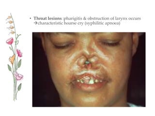 • Throat lesions :pharigitis & obstruction of larynx occurs
characteristic hoarse cry (syphilitic apnoea)
 