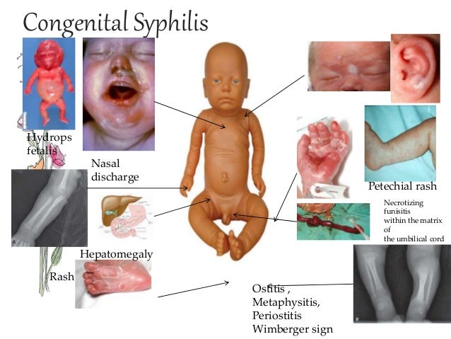 Congenital Syphilis - Dermatology