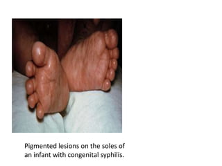 congenital syphilis.pptx