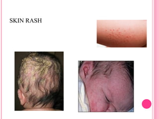 Syphills Rash Baby a brief discription on Congenital Syphilis.ppt