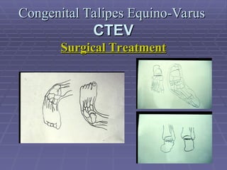 Congenital Talipes Equino-Varus.ppt Congenital Talipes Equino-Varus.ppt
