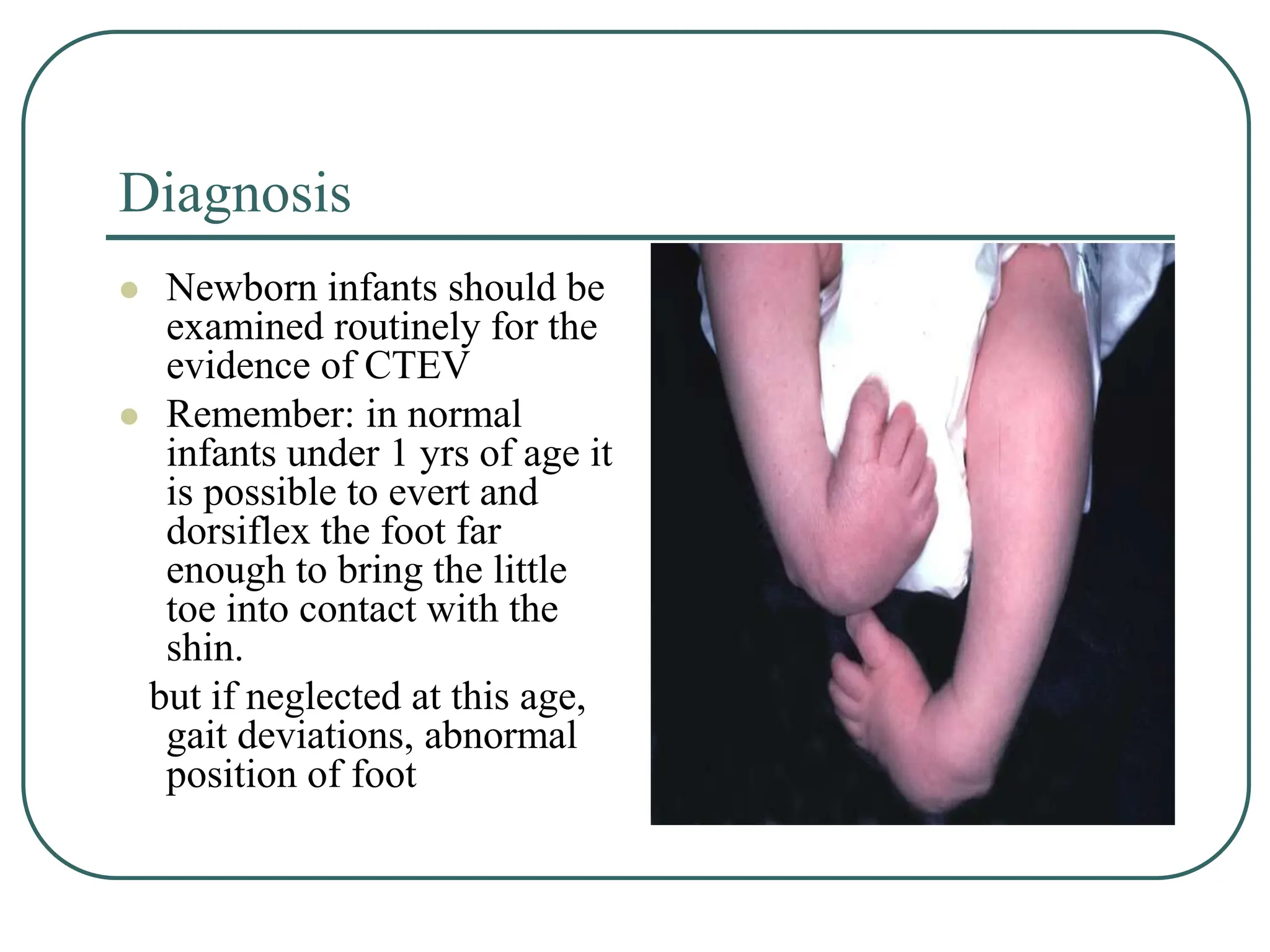 Congenital Talipes Equino Varus.pptjeiiieiu | PPT