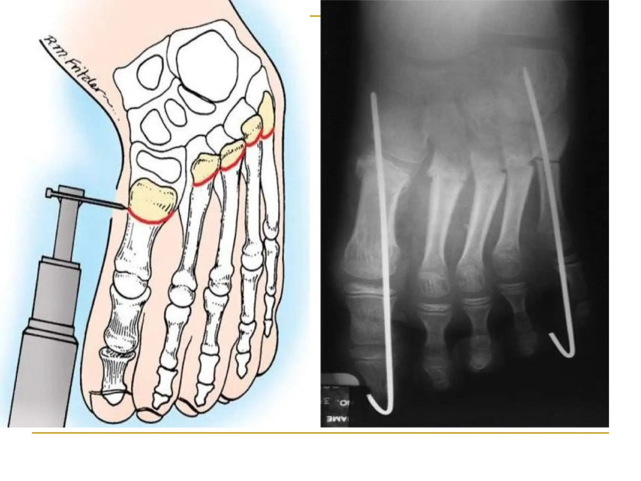 Unlocking The Mystery Of Equino Varus: Causes, Symptoms, And More - tzofucq