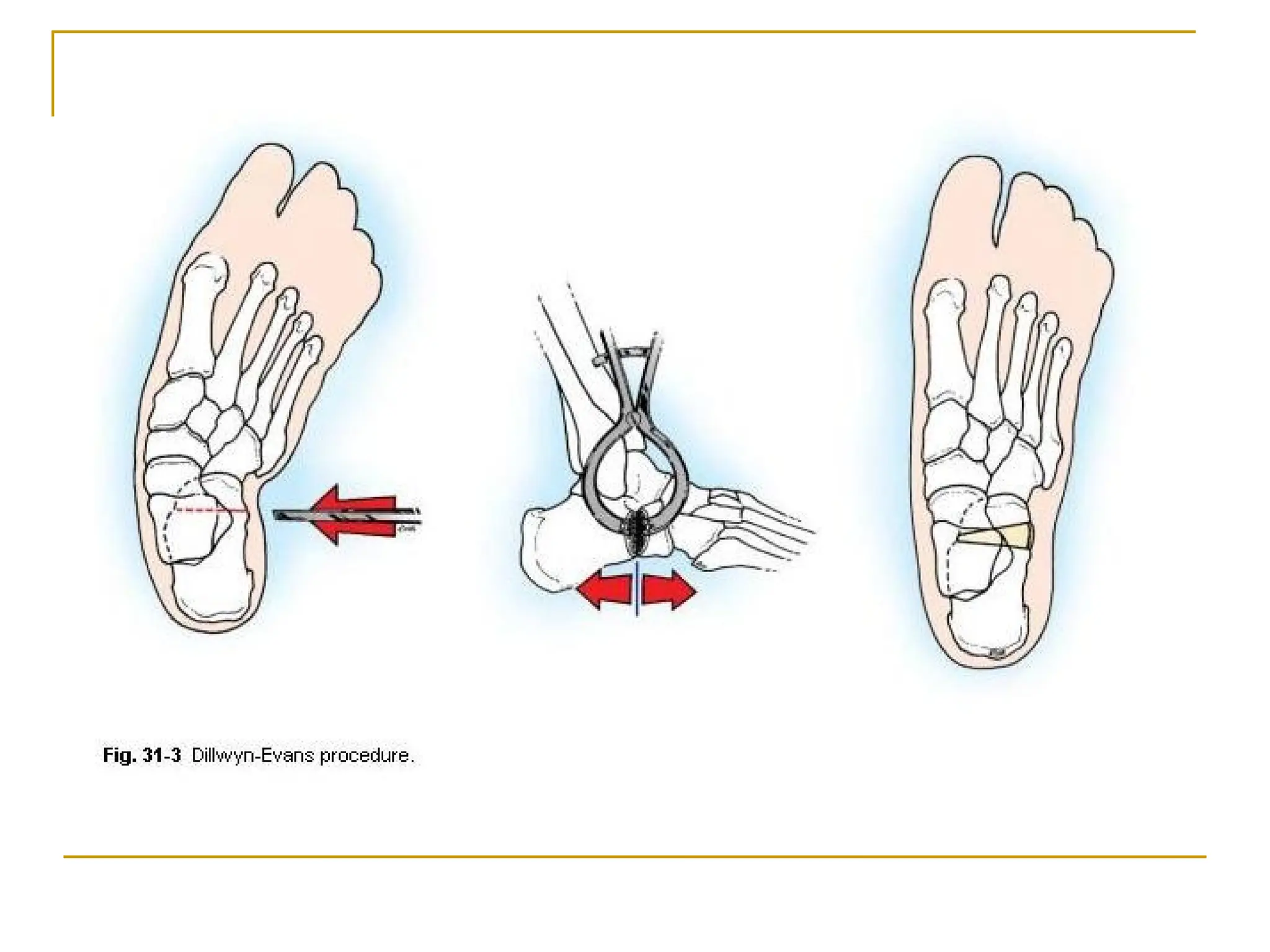Unlocking The Mystery Of Equino Varus: Causes, Symptoms, And More - wsvrmuj