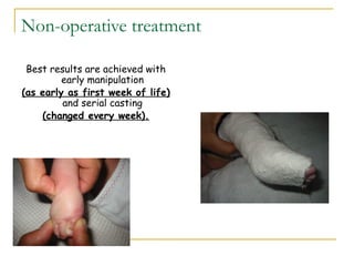 Equino Varus Preventing Long Term Complications - pafkiqu