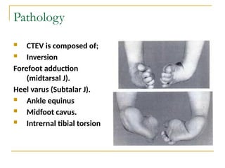 Congenital Talipes Equino Varus deformity.pptx