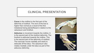 Congenital Talipes Equinovarus_Group 4..pptx