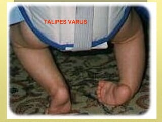 CONGENITAL TALIPES EQUINO VARUS & SPINA BIFIDA | PPT