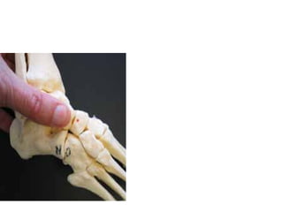 Congenital talipes equinus varus (CTEV).pptx