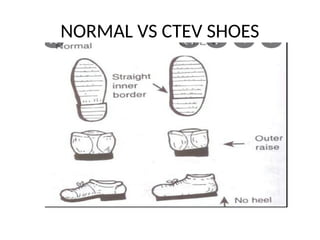 Ctev Types Congenital talipes equinus varus (CTEV).pptx