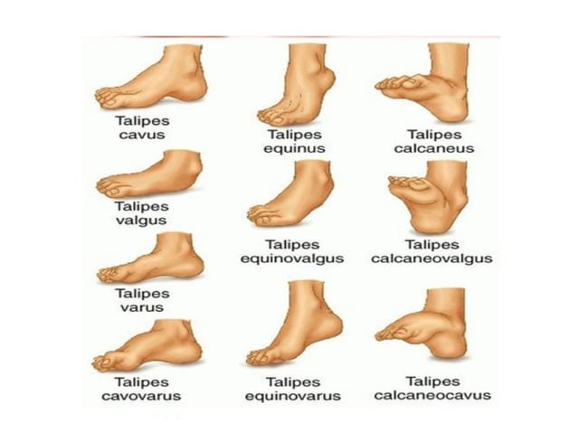 congenital-talipes-equinus-varus-ctev-pptx