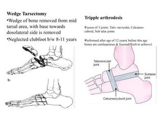 Parsectomy Congenital talipes equinus varus (CTEV).pptx