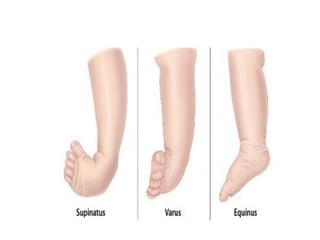 Ctev Types Congenital talipes equinus varus (CTEV).pptx