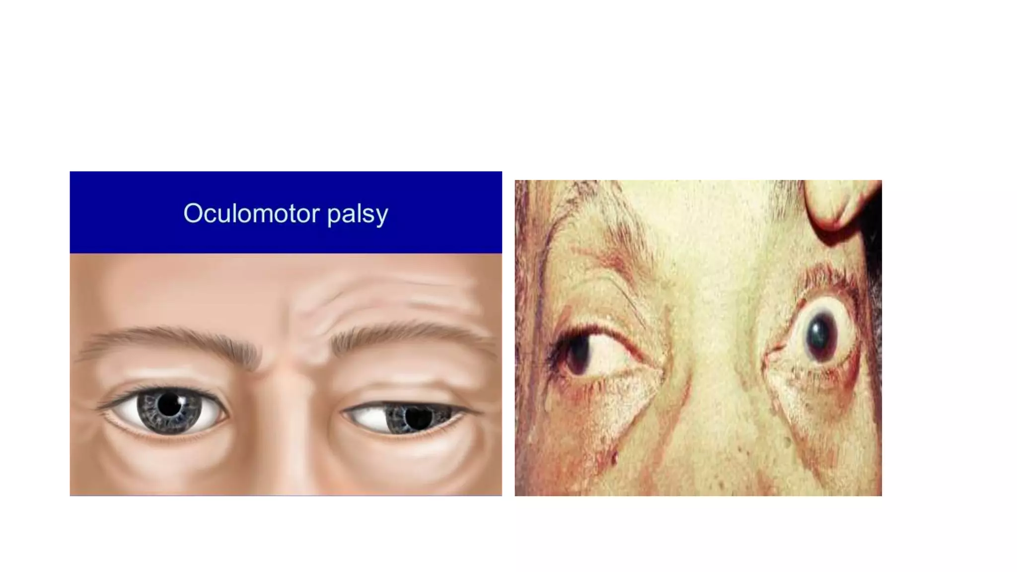 Congenital third ( oculomotor )nerve palsy | PPTX