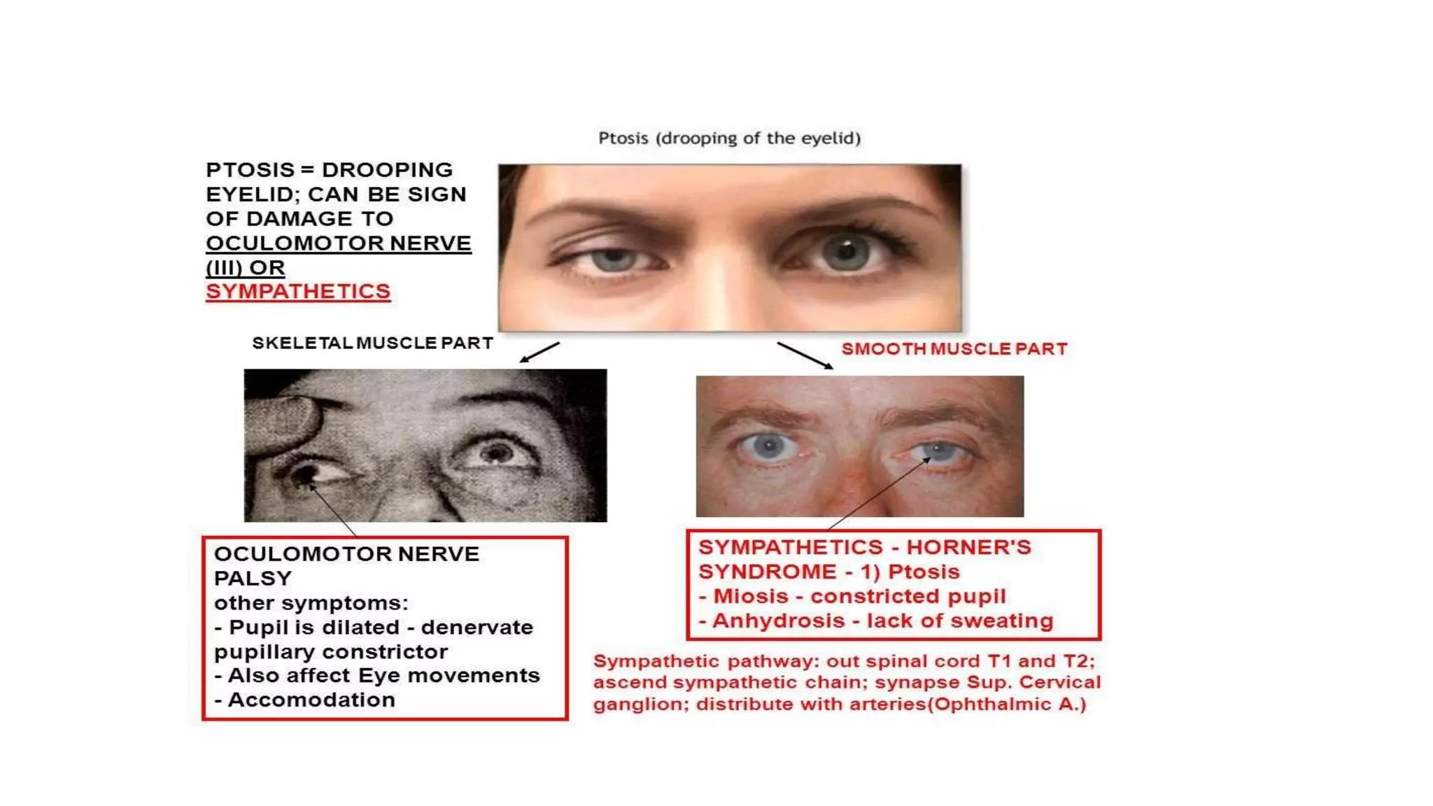 Oculomotor Nerve Palsy Features