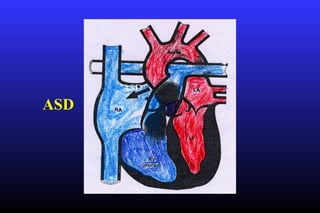 Congenital heart disease for post graduates toufiqur rahman NICVD | PPT