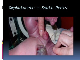 Omphalocele - Small Penis 
 
