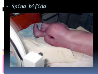 - Spina bifida 
 