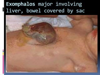 Exomphalos major involving 
liver, bowel covered by sac 
 
