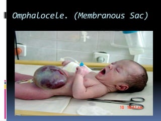 Omphalocele. (Membranous Sac) 
 