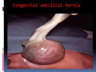 Congenital umbilical hernia 
 