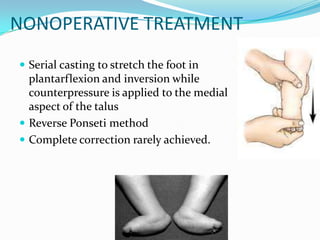 Congenital vertical talus UG lecture | PPTX