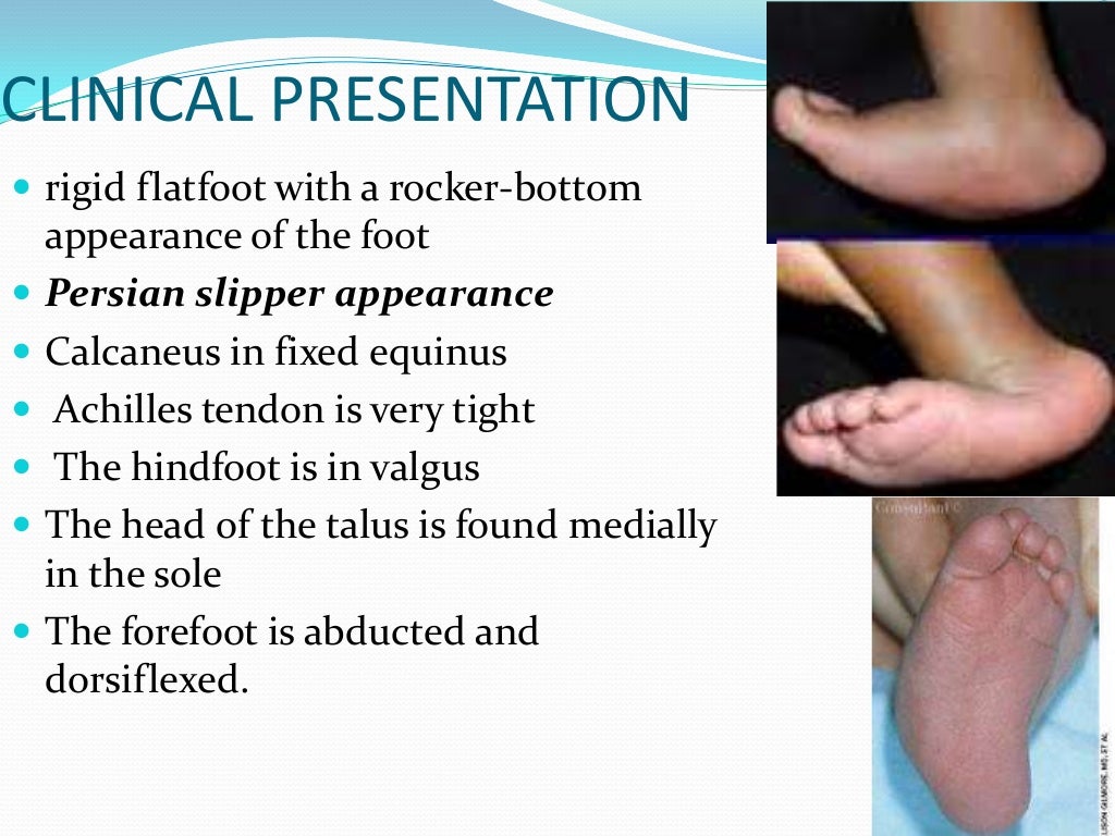 Congenital vertical talus UG lecture