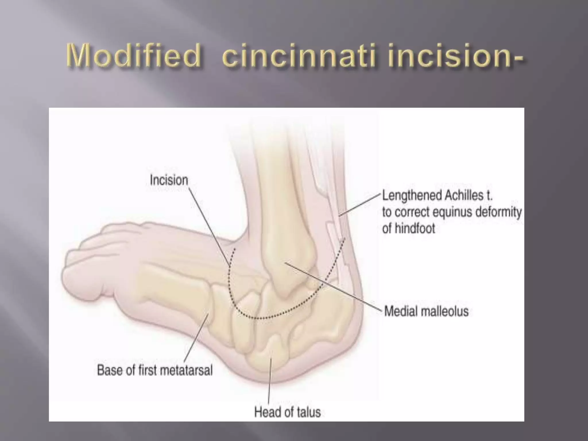 Talus Slides Congenital vertical talus | PPTX