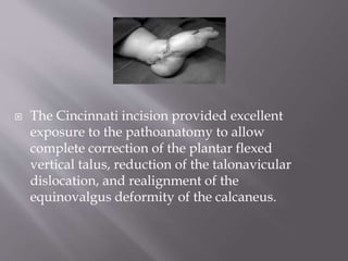 Congenital vertical talus | PPTX