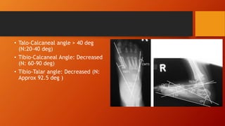 Talar Angle Congenital vertical talus | PPTX